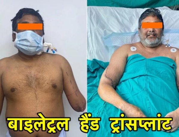 Bilateral Hand Transplant: दिल्ली के चिकित्सकों ने पेंटर को दिये नये हाथ