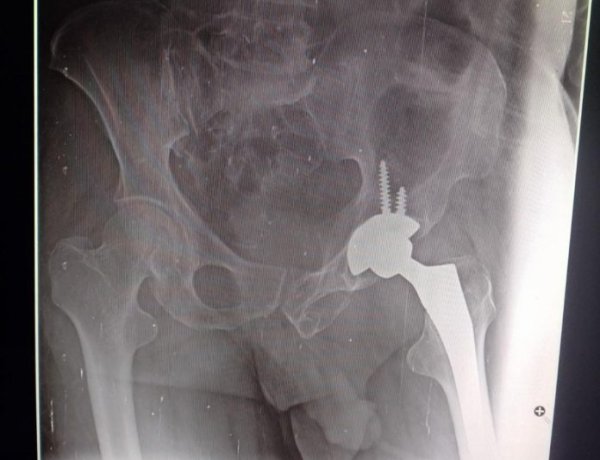 आयुष्मान भारत के तहत द्वारिका अस्पताल में टूटे कूल्हे का सफल ऑपरेशन किया गया