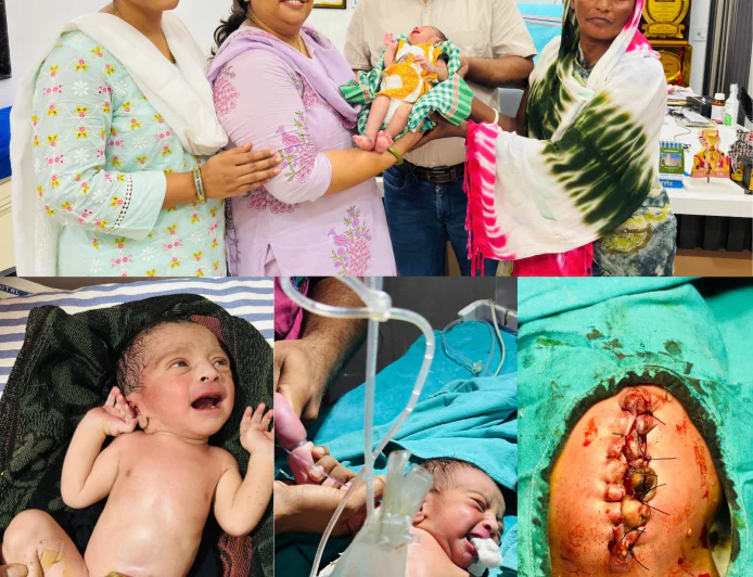 प्रकाश मल्टीस्पेशियलिटी हॉस्पिटल में दो चरणों की जटिल सर्जरी से नवजात को मिला नया जीवन, जन्म के समय पेट के बाहर थी पूरी आंत
